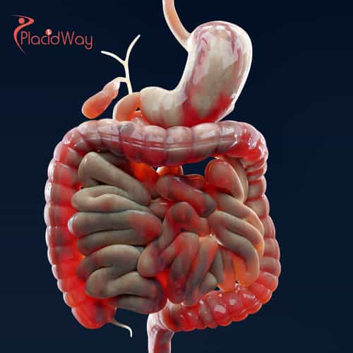 Advanced Crohns Disease Stem Cell Therapy in Japan: A Complete Guide